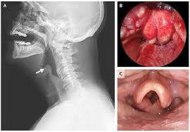Image result for Epiglottitis