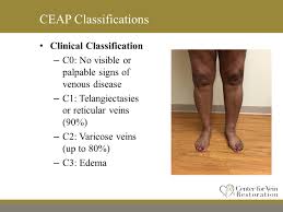 Understanding Ceap Classification For Venous Insufficiency Ppt Video Online Download