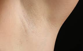 It can also treat sensitive areas like the bikini line, chest, and nipple area. Coolglide Laser Hair Removal Spa Cielo Cabo