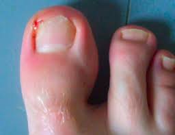 Image result for Paronychia feet