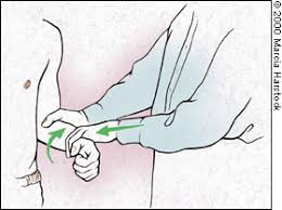 Image result for Yergason Test