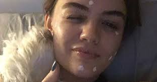 Milia are small cysts that form when dead skin cells get trapped under your skin. Cystic Acne Treatments And Causes Explained By Dermatologists Teen Vogue