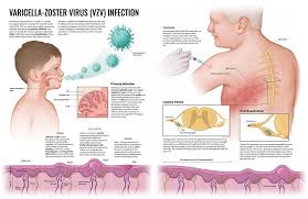Image result for Varicella zoster on human skin