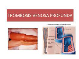 Las trombosis venosas que se producen en el sistema venoso profundo son más importantes 2.8 prevención se pueden tomar varias medidas para evitar la trombosis venosa profunda tales. Trombosis Venosa Profunda