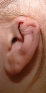 Reconstruction Of Ear Deformity From Post Piercing Perichondritis