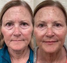 Maggie Cadavero — Botox, Filler, Fat Removal │ Aluma Medical Aesthetics