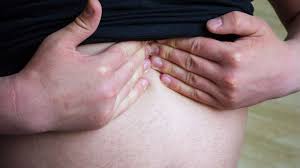 Image result for stomach hernia symptoms