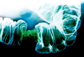 But some of the most notable indicators can be found in your stools. More Young People Are Dying Of Colon Cancer The New York Times