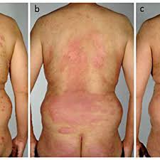 It's a case of recalcitrant eczema. Pdf Adalimumab In Recalcitrant Severe Psoriasis Associated With Atopic Dermatitis