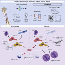 Several types of cancer, including multiple myeloma, leukemia, and multiple myeloma is a type of cancer that occurs in the plasma cells, which form in the bone marrow. Heterogeneous Bone Marrow Stromal Progenitors Drive Myelofibrosis Via A Druggable Alarmin Axis Sciencedirect