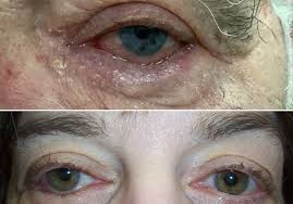 Image result for Entropion