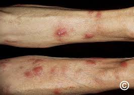 Image result for Panniculitis