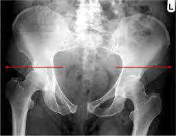 Documents similar to systematic review of pelvical xray. The Pelvis And Hip