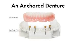 If you are a veteran researching dental implant options, please contact your local va office or your current dentist to see if here's how it works: The Difference Between Implant Anchored Dentures And Single Tooth Dental Implants Renew Anchored Dentures