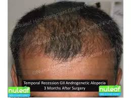 How Does Hair Grow After Hair Transplant Surgery Quora