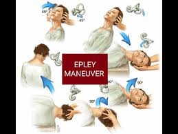 Image result for Canalith Repositioning Procedure