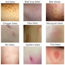 Image result for bedbugs bites