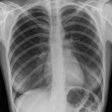 Jul 02, 2021 · a collapsed lung occurs when air escapes from the lung. Pneumothorax Radiology Case Radiopaedia Org