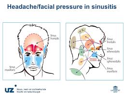 Acute Rhinosinusitis Bacterial Infection Or Inflammation Prof Dr Ppt Video Online Download