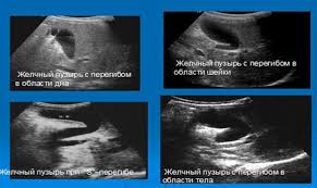 Pundi hempedu menumpukan hempedu dan fungsi saluran biliary ia dijalankan di bawah pengaruh peraturan neurohumoral. Penebalan Pundi Hempedu Penyatuan Dinding Pundi Hempedu Apakah Itu Penyebab Rawatan