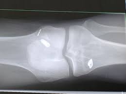 Oft kommen patienten um eine operation nicht herum. Ruckstande Nahtmaterial Schrauben Nach Kreuzband Op Operation Orthopadie Knoten