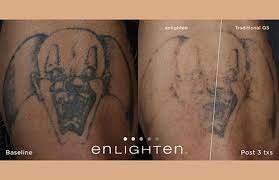 See results after 3 treatments. Laser Tattoo Removal Arkansas Laser And Skin Care