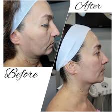 A real plasma device that delivers real results! 🤩🖊️ 🌍 www.plasmapen.com  📧 info@plasmapenuk.com #skintighteningtreatment #skinimprovement #skinglow  #acnecure #scartreatment #crowsfeet #plasmapeel #eyelift #facelift  #necklift #sundamage ...