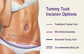 In fact, the tummy tuck has to be accompanied by the liposuction procedure to get the best results. Dr Salomon The Best Tummy Tuck In Miami Florida