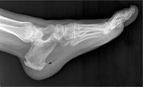 You could have a risk factor that is associated with your muscles, including weakness of the calf or foot muscles, and tightness of the hamstrings or the achilles tendon which is the tendon that connect your. Diagnosis And Treatment Of Plantar Fasciitis American Family Physician