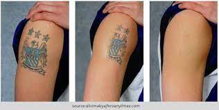 Tattoo ink is placed beneath the top layer of the skin. How To Remove A Permanent Tattoo Diy Methods And Surgical Methods