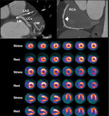 Image result for Nuclear Ventriculogram