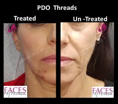 Thread lift before and after jowls. Pdo Thread Lift Fix Sagging Jowls Non Surgical Face Lift