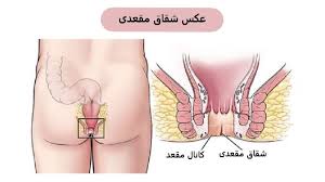 رابطه مقعدي عکس مقعده سالم. Ø¨ÙˆØ§Ø³ÙŠØ± ÙŠØ§ Ù‡Ù…ÙˆØ±ÙˆØ¦ÙŠØ¯ Ú†ÙŠØ³Øª Ùˆ Ø±Ø§Ù‡ Ù‡Ø§ÙŠ Ø¯Ø±Ù…Ø§Ù† Ø¨ÙŠÙ…Ø§Ø±ÙŠ Ù‡Ù…ÙˆØ±Ø¦ÙŠØ¯ ÙŠØ§ Ø¨ÙˆØ§Ø³ÙŠØ±
