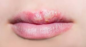 Aug 30, 2019 · whichever name you prefer for these sores that tend to develop on the lip or around the mouth, you can blame the herpes simplex virus, usually type 1, for them. How To Get Rid Of A Cold Sore In 3 Days Flat Blog Huda Beauty