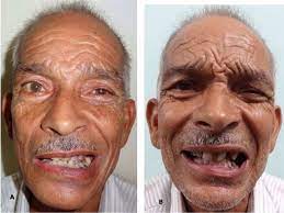 We did not find results for: Unilateral Facial Palsy In Guillain Barre Syndrome Gbs A Rare Occurrence Bmj Case Reports