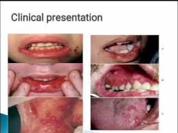 The herpes simplex virus is categorized into 2 types: Acute Primary Herpetic Gingivostomatitis Youtube