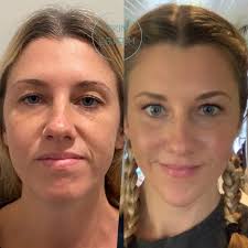 Before facial Optimization and a month after! Goals met!!! Just a little  filler & skin care. Boom!!! 👇 CONSERVATIVE❤️TASTEFUL❤️YOU 👇 To see me Dawn  Naylor (board certified Nurse Practitioner, CANS), Chelsea Mallows (