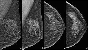 Top exercises for breast cancer and breast health. Application Of Artificial Intelligence Based Computer Assisted Diagnosis On Synthetic Mammograms From Breast Tomosynthesis Comparison With Digital Mammograms Springerlink