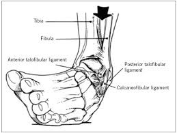 May 31, 2021 · the lateral collateral ligament is a strong compound ligament that reinforces the lateral aspect of the ankle joint. The Weekend Athlete Common Foot And Ankle Injuries Consultant360