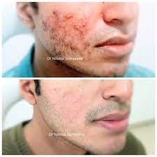 During the consultation, a dermatologist will examine your skin, playing close if you have taken isotretinoin to treat acne, be sure to tell your dermatologist before treatment for acne scars begins. Acne Scars Treatment In Mumbai Cost Before After Results Laser