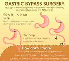 Gastric Bypass Surgery Is That It Decreases The Stomach Capacity Thus Restricting Food Consumption And Reroutes The Food Consumed For Lesser Calorie Absorpti