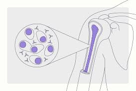 Image result for Multiple Myeloma