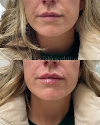 ✨ Why Radiesse is one of our favorite treatments ✨ Radiesse does more than  just add volume — it helps your skin rebuild itself from within. 💉💫  Here's why we love it: