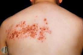 Foarte eficiente in acest sens sunt. Zona Zoster Sos Dermatolog