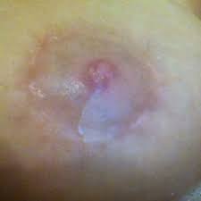 By checking this box you hereby agree to hold west end plastic surgery, its doctors and affiliates, harmless from any hacking or any other unauthorized use of your personal information by outside parties. Areola Reduction Scars 5 Months Post Op Does It Look Normal Photo