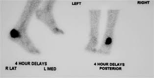 Image result for Osteomyelitis Bone Scan