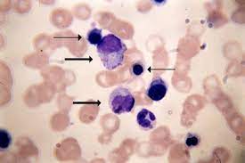 Das krankheitsspektrum ist heterogen und reicht von isoliertem. 76 Jahriger Patient Mit Nicht Bestatigtem Verdacht Auf Idiopathische Myelofibrose Springerlink