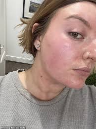 Woman reveals how her face DOUBLED in size due to sun poisoning