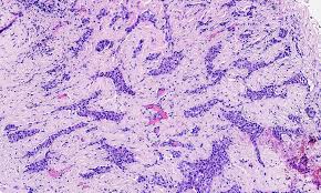 Benign multicystic peritoneal mesothelioma (bmpm) is a completely rare benign cystic tumor springing up from the peritoneal mesothelium (lining of. Pathology Outlines Mesothelioma Pleura Epithelioid