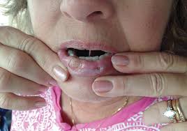 Maybe you heard or read about it on the web somewhere? Oral Mucosal Lesions Associated With Overlapping Psychodermatologic Disorders Compendium